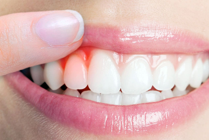 Diş Eti Hastalıkları Tedavisi (Periodontal Tedavi)