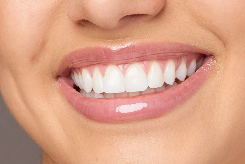 Hollywood Smile (Gülüş Tasarımı)